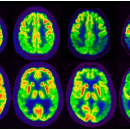PET-TAC Cerebral con FDG en Reus